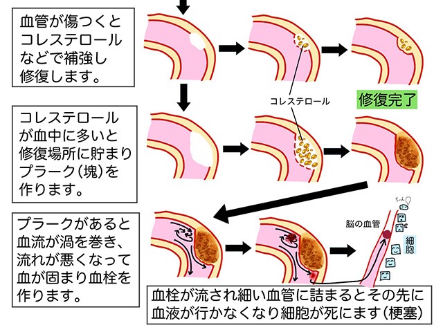 LDL-コレステロールが血管に及ぼす影響