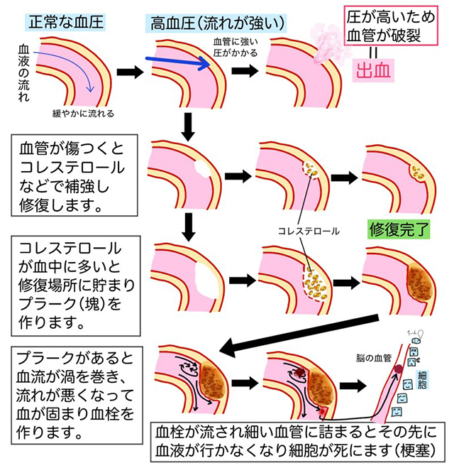 高血圧が及ぼす悪影響